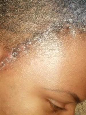 2nd Brain Surgery